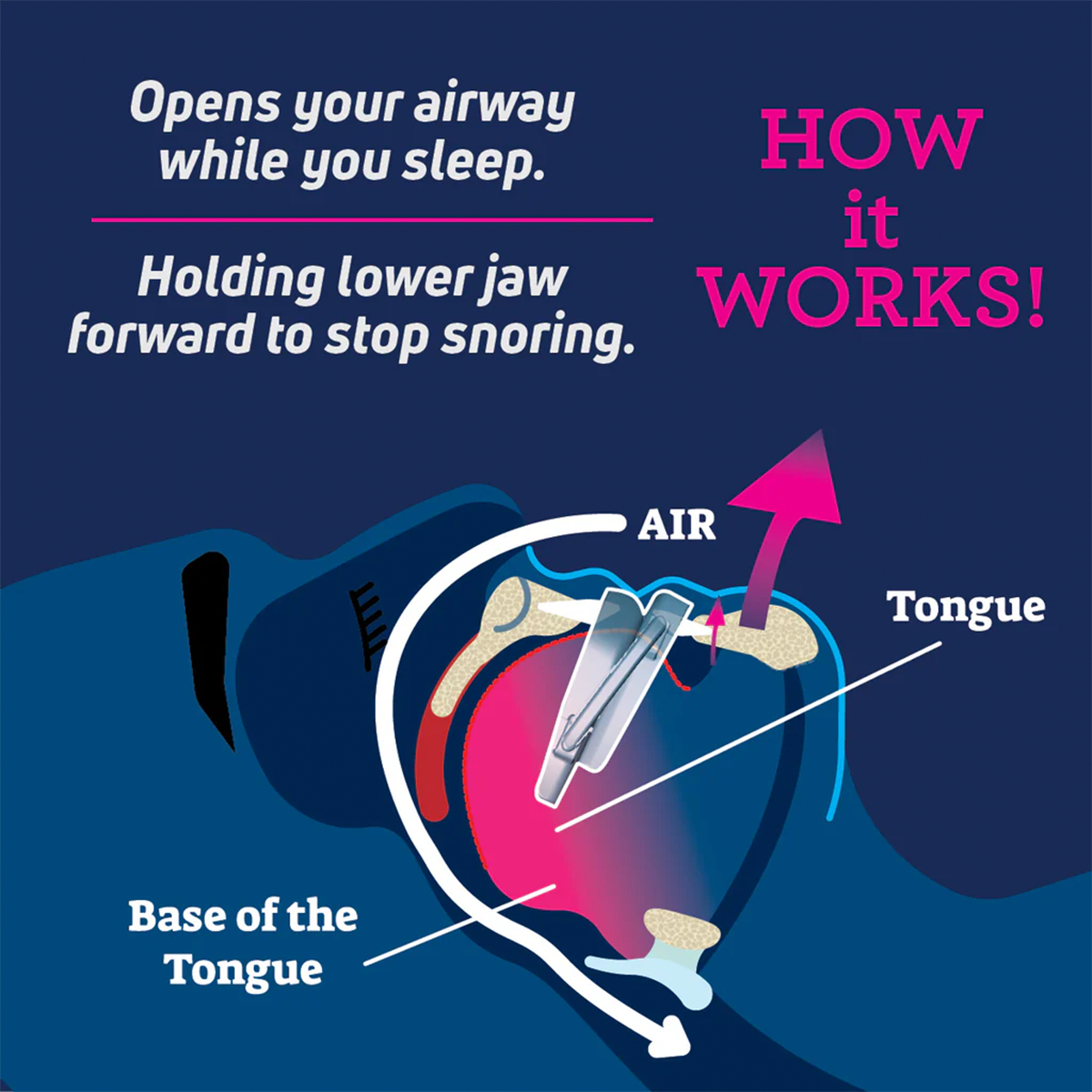 SmartGuard Anti-Snore Device